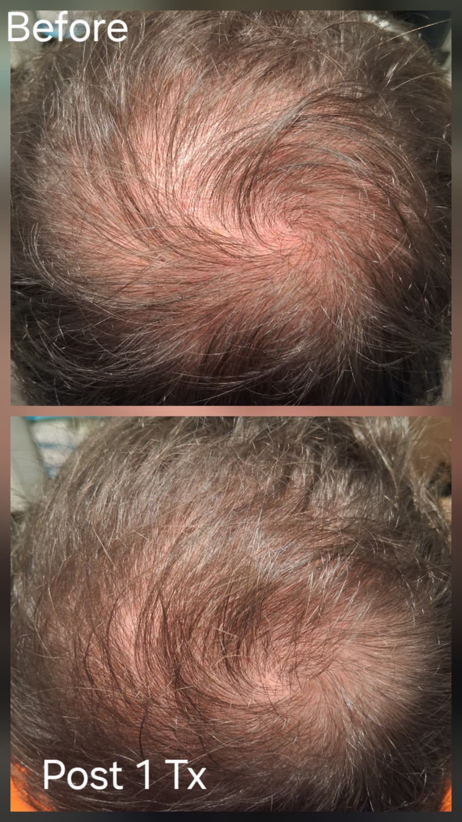 Hair restoration result